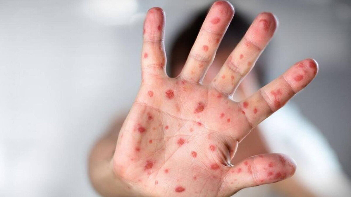 περιστατικά της ευλογιάς των πιθήκων - monkeypox